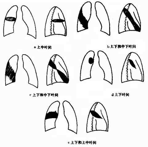 叶间积液的各种X线表现(正、侧位象)