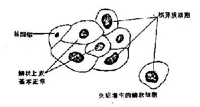 高分化鳞癌与鳞状化生, 核异质细胞鉴别示意图