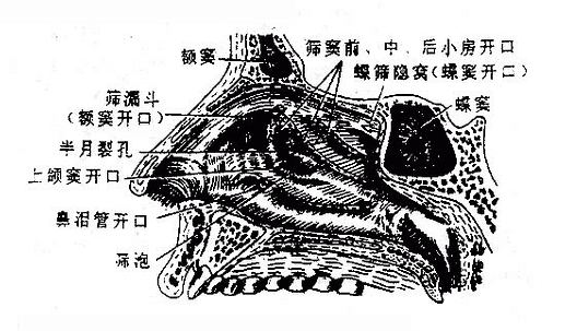 鼻腔外侧壁(鼻甲切除)