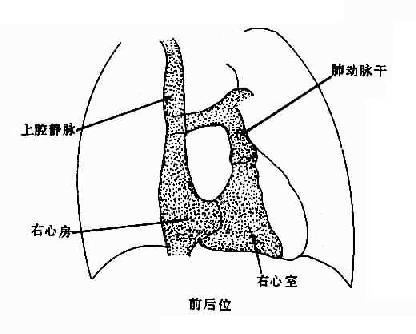 正常腔静脉,右心房、室造影示意图