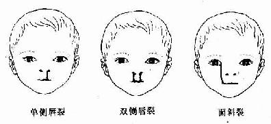 颜面畸形